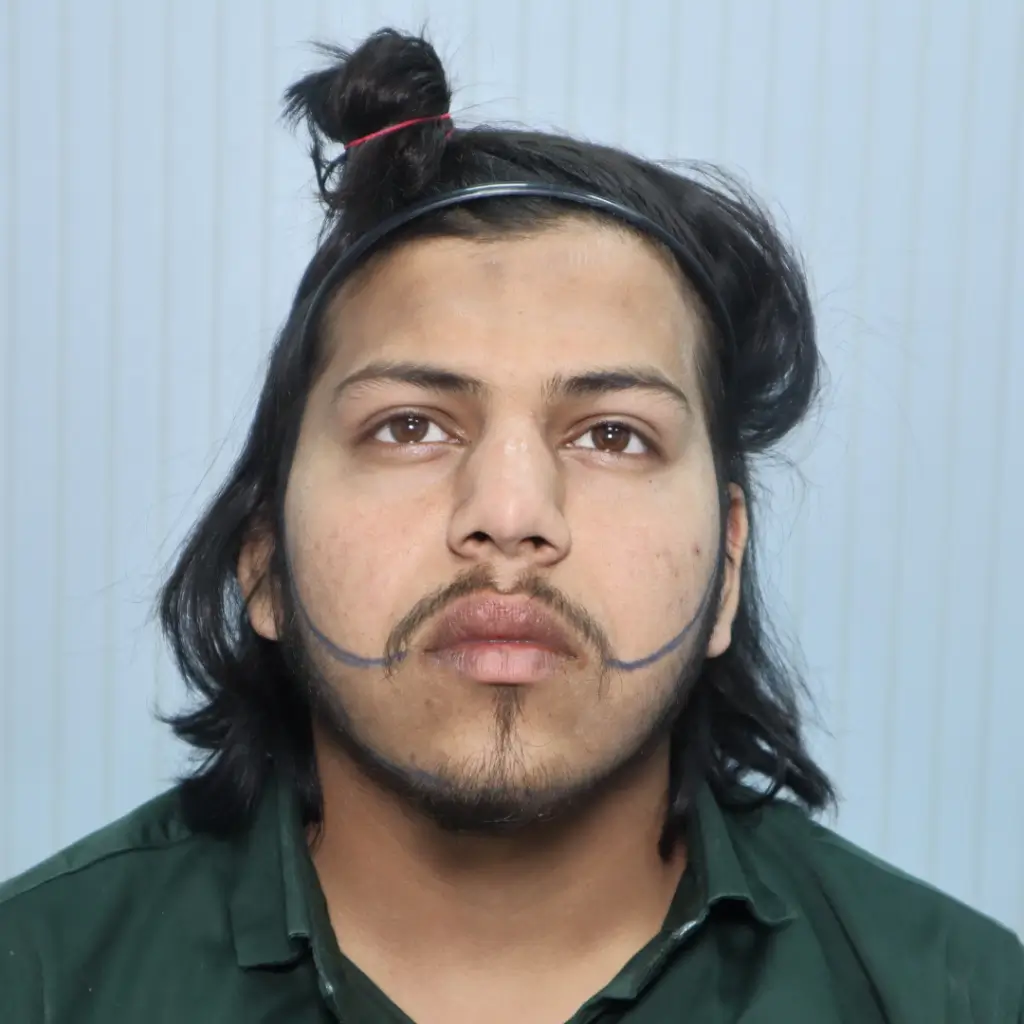 BEARD-TRANSPLANT-1024x1024