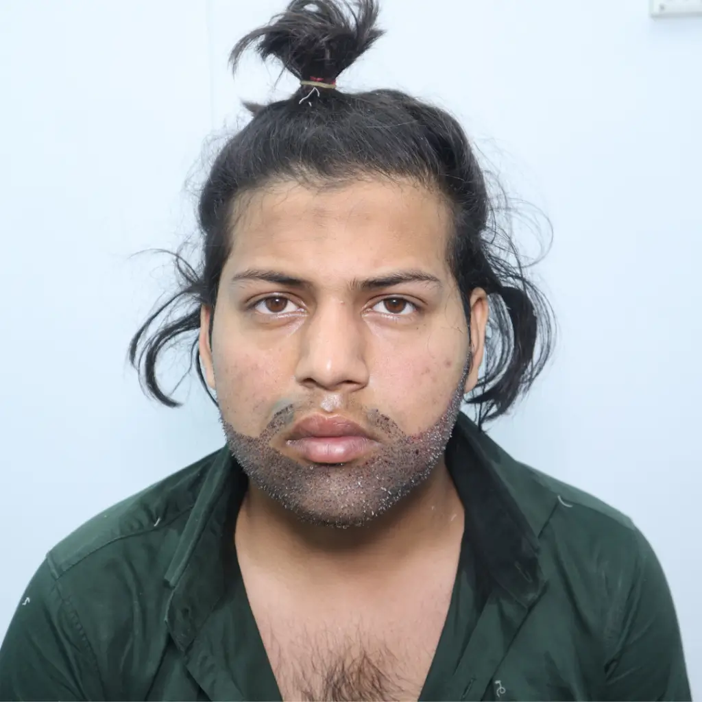 BEARD-TRANSPLANT-2-1024x1024